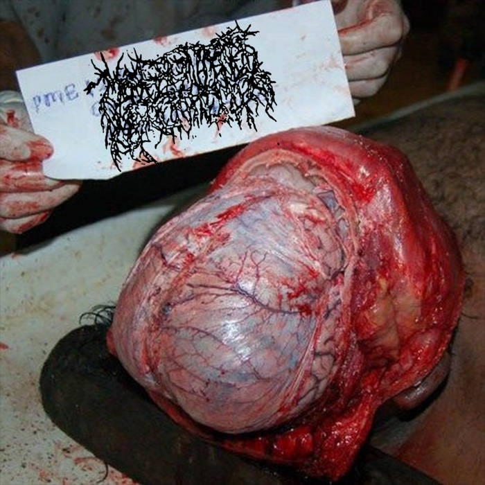 Malignant Hyperthermia – Cutaneous Blastomycosis CD